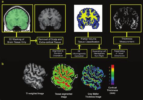 cortical thickness measurement|cortical thickness map.